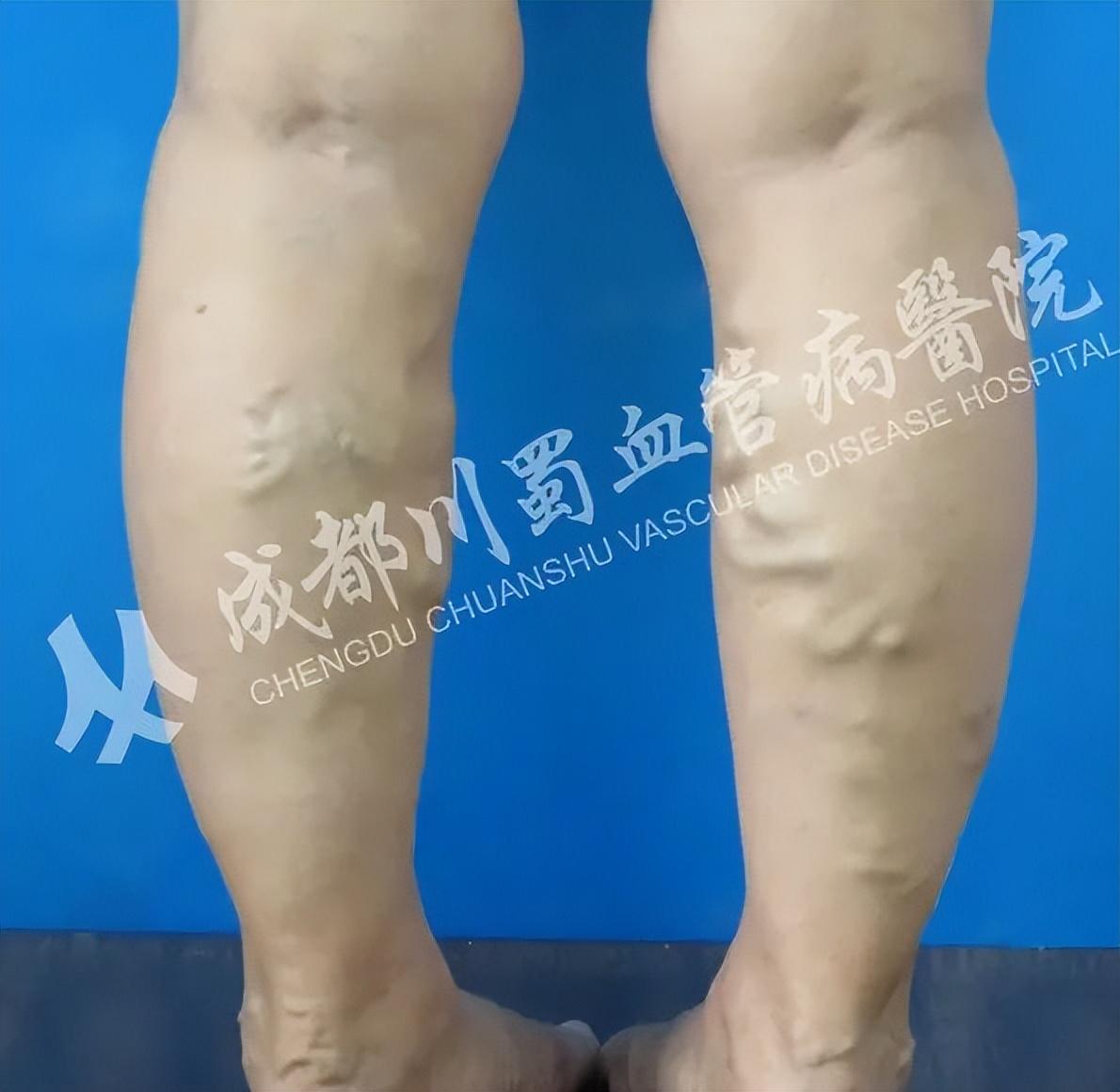 老爛腿新療法詳解，創(chuàng)新方法重塑治療老爛腿的未來