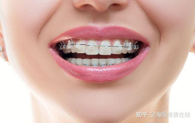 陶瓷牙套價格探秘，小巷中的隱秘寶藏，全方位解析費用